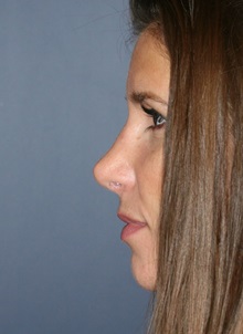 Rhinoplasty After Photo by Steve Laverson, MD, FACS; Rancho Santa Fe, CA - Case 34307