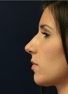 Rhinoplasty Before Photo by Steve Laverson, MD, FACS; Rancho Santa Fe, CA - Case 34307