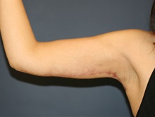 Arm Lift After Photo by Steve Laverson, MD, FACS; Rancho Santa Fe, CA - Case 34309