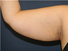 Arm Lift Before Photo by Steve Laverson, MD, FACS; Rancho Santa Fe, CA - Case 34309