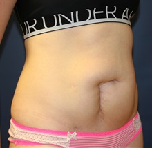Tummy Tuck Before Photo by Steve Laverson, MD, FACS; Rancho Santa Fe, CA - Case 34310