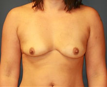 Breast Augmentation Before Photo by Steve Laverson, MD, FACS; Rancho Santa Fe, CA - Case 34312