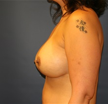Breast Augmentation After Photo by Steve Laverson, MD, FACS; Rancho Santa Fe, CA - Case 34312