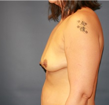 Breast Augmentation Before Photo by Steve Laverson, MD, FACS; Rancho Santa Fe, CA - Case 34312