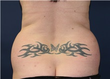 Liposuction Before Photo by Steve Laverson, MD, FACS; Rancho Santa Fe, CA - Case 34348