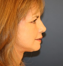 Facelift After Photo by Steve Laverson, MD, FACS; San Diego, CA - Case 34349