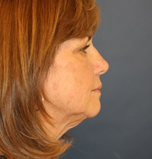 Facelift Before Photo by Steve Laverson, MD, FACS; San Diego, CA - Case 34349