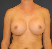 Breast Augmentation After Photo by Steve Laverson, MD; San Diego, CA - Case 34523