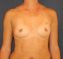 Breast Augmentation Before Photo by Steve Laverson, MD; San Diego, CA - Case 34523