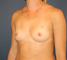 Breast Augmentation Before Photo by Steve Laverson, MD, FACS; Rancho Santa Fe, CA - Case 34523