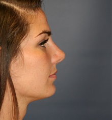 Rhinoplasty After Photo by Steve Laverson, MD, FACS; Rancho Santa Fe, CA - Case 34961