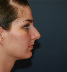 Rhinoplasty Before Photo by Steve Laverson, MD, FACS; Rancho Santa Fe, CA - Case 34961