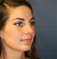 Rhinoplasty After Photo by Steve Laverson, MD, FACS; Rancho Santa Fe, CA - Case 34961