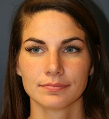 Rhinoplasty After Photo by Steve Laverson, MD, FACS; Rancho Santa Fe, CA - Case 34961