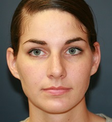 Rhinoplasty Before Photo by Steve Laverson, MD, FACS; Rancho Santa Fe, CA - Case 34961