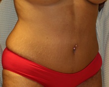 Tummy Tuck After Photo by Steve Laverson, MD, FACS; Rancho Santa Fe, CA - Case 34962