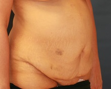 Tummy Tuck Before Photo by Steve Laverson, MD, FACS; Rancho Santa Fe, CA - Case 34962