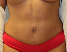 Tummy Tuck After Photo by Steve Laverson, MD, FACS; Rancho Santa Fe, CA - Case 34962