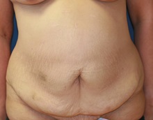 Tummy Tuck Before Photo by Steve Laverson, MD, FACS; Rancho Santa Fe, CA - Case 34962