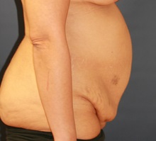 Tummy Tuck Before Photo by Steve Laverson, MD, FACS; Rancho Santa Fe, CA - Case 34962