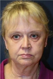 Facelift Before Photo by Steve Laverson, MD, FACS; San Diego, CA - Case 35156