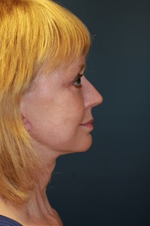 Facelift After Photo by Steve Laverson, MD, FACS; San Diego, CA - Case 35156