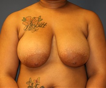 Breast Reduction Before Photo by Steve Laverson, MD, FACS; San Diego, CA - Case 35158