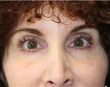 Eyelid Surgery After Photo by Steve Laverson, MD, FACS; San Diego, CA - Case 35159