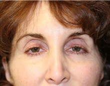 Eyelid Surgery Before Photo by Steve Laverson, MD, FACS; Rancho Santa Fe, CA - Case 35159