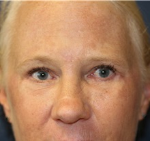 Eyelid Surgery After Photo by Steve Laverson, MD, FACS; San Diego, CA - Case 35160