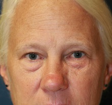Eyelid Surgery Before Photo by Steve Laverson, MD, FACS; San Diego, CA - Case 35160