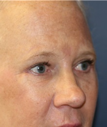 Eyelid Surgery After Photo by Steve Laverson, MD, FACS; Rancho Santa Fe, CA - Case 35160