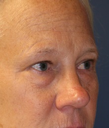 Eyelid Surgery Before Photo by Steve Laverson, MD, FACS; Rancho Santa Fe, CA - Case 35160