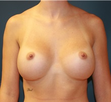 Breast Augmentation After Photo by Steve Laverson, MD, FACS; Rancho Santa Fe, CA - Case 35162