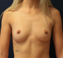 Breast Augmentation Before Photo by Steve Laverson, MD, FACS; Rancho Santa Fe, CA - Case 35162