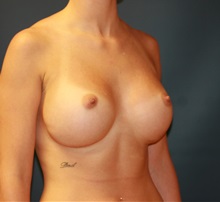 Breast Augmentation After Photo by Steve Laverson, MD, FACS; Rancho Santa Fe, CA - Case 35162