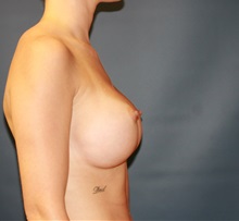 Breast Augmentation After Photo by Steve Laverson, MD, FACS; Rancho Santa Fe, CA - Case 35162