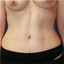 Tummy Tuck After Photo by Steve Laverson, MD; San Diego, CA - Case 36576