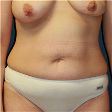 Tummy Tuck Before Photo by Steve Laverson, MD; San Diego, CA - Case 36576