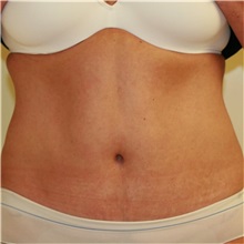 Tummy Tuck After Photo by Steve Laverson, MD, FACS; Rancho Santa Fe, CA - Case 36577