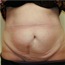 Tummy Tuck Before Photo by Steve Laverson, MD, FACS; Rancho Santa Fe, CA - Case 36577