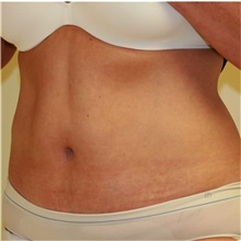 Tummy Tuck After Photo by Steve Laverson, MD, FACS; Rancho Santa Fe, CA - Case 36577