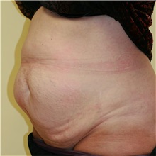 Tummy Tuck Before Photo by Steve Laverson, MD, FACS; Rancho Santa Fe, CA - Case 36577