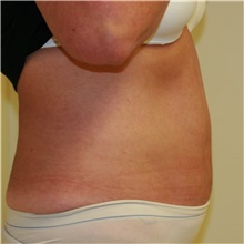 Tummy Tuck After Photo by Steve Laverson, MD, FACS; Rancho Santa Fe, CA - Case 36577