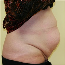 Tummy Tuck Before Photo by Steve Laverson, MD, FACS; Rancho Santa Fe, CA - Case 36577