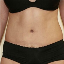 Tummy Tuck After Photo by Steve Laverson, MD, FACS; San Diego, CA - Case 36578