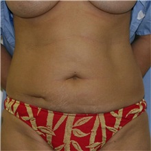 Tummy Tuck Before Photo by Steve Laverson, MD, FACS; San Diego, CA - Case 36578