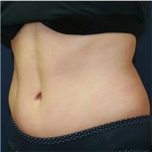Tummy Tuck After Photo by Steve Laverson, MD; San Diego, CA - Case 36579
