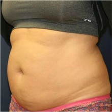 Tummy Tuck Before Photo by Steve Laverson, MD; San Diego, CA - Case 36579