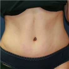 Tummy Tuck After Photo by Steve Laverson, MD, FACS; Rancho Santa Fe, CA - Case 36579